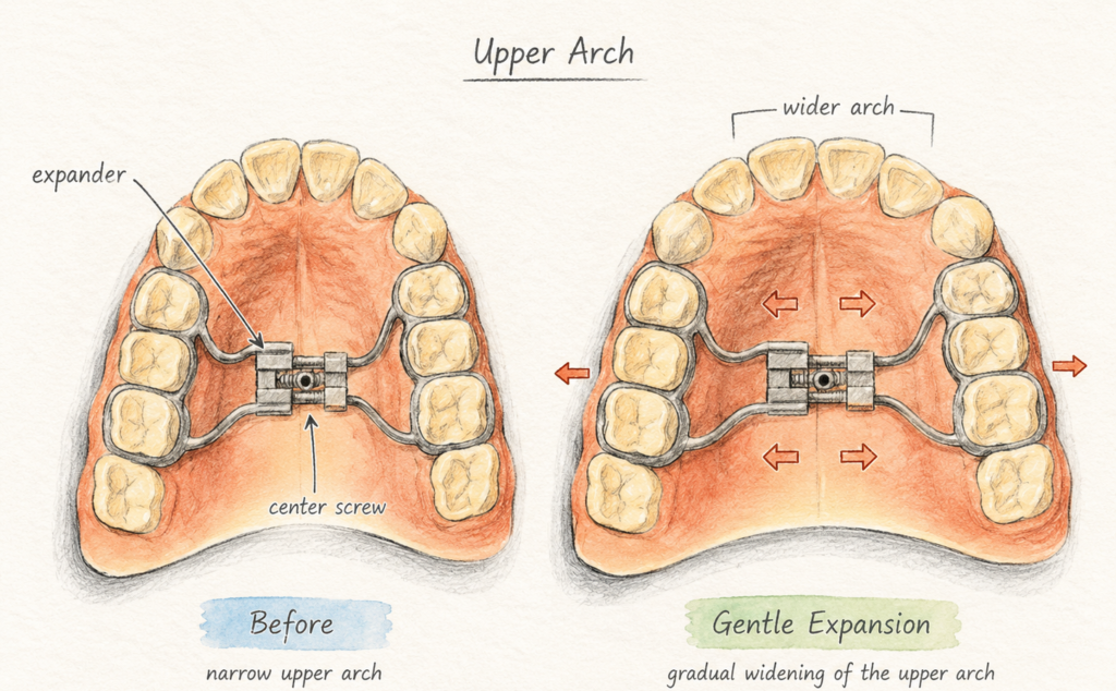 Palatal Expander for Crossbite