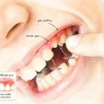 molar broke off at gum line