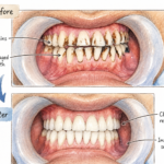 stained teeth from braces